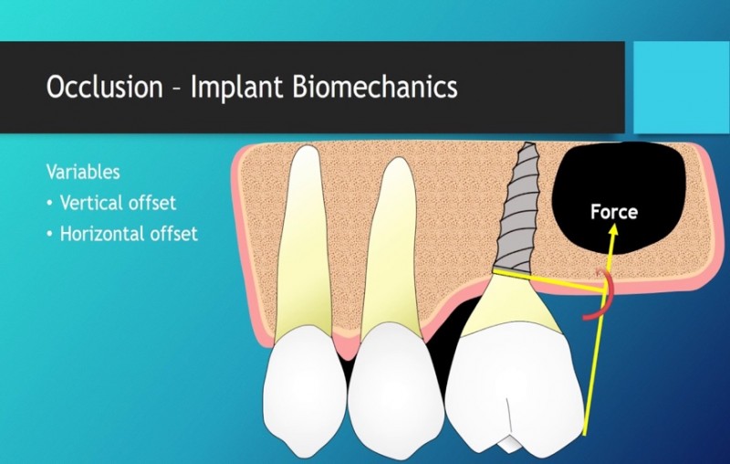 A diagram of implants and implants

Description automatically generated