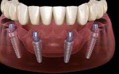 大天使植牙專科周啓誠醫生專欄-- 如何一天重建全口牙？什麽是“All on 4”最新快速植牙？