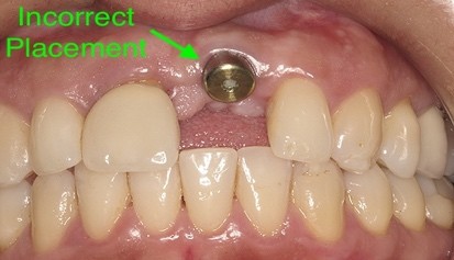 Close-up of a person's teeth with a screw in their mouth

Description automatically generated