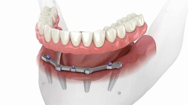 A close-up of a model of teeth

Description automatically generated