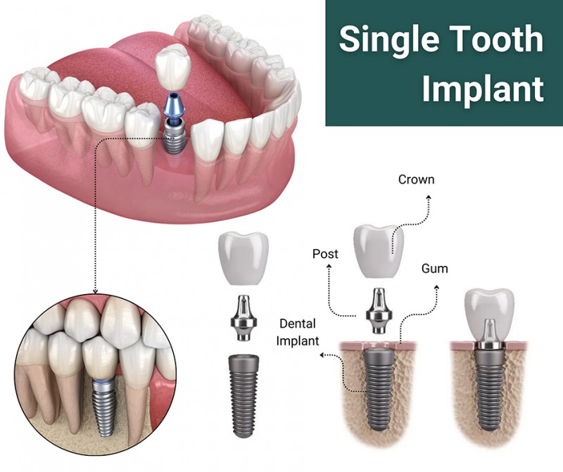 A diagram of a single tooth implant

Description automatically generated