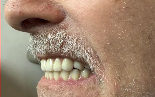 大天使植牙专科  周启诚医生专栏 12 – 全牙弓种植修复体的 2 种最常见修复体分类类型！