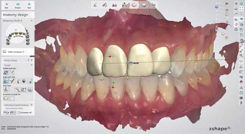 A screenshot of a computer generated model of teeth

Description automatically generated