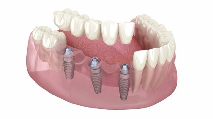 A model of a human jaw

Description automatically generated