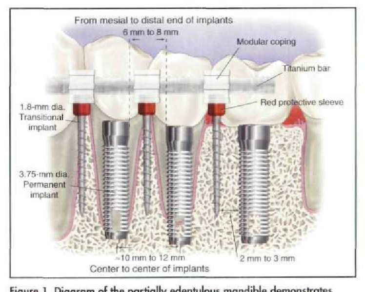 Diagram of a diagram of dental implants

Description automatically generated