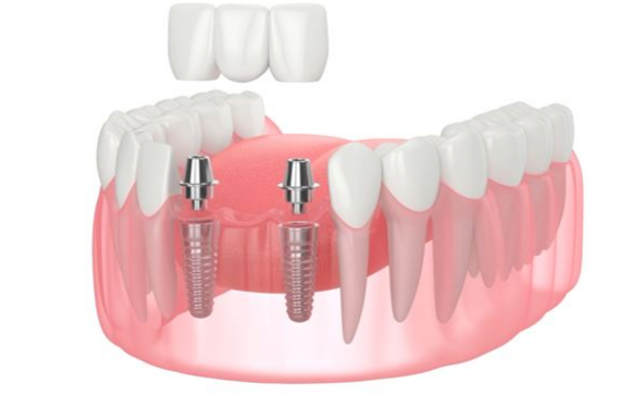 大天使植牙专科诊所周啓诚医生专栏3---单颗植牙和全口速定植牙的费用是多少？