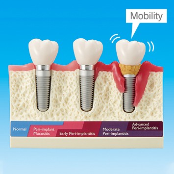 A model of teeth with implants

Description automatically generated