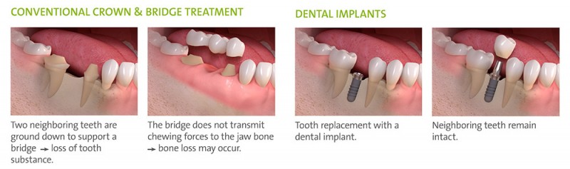 A close-up of teeth and dental implants

Description automatically generated