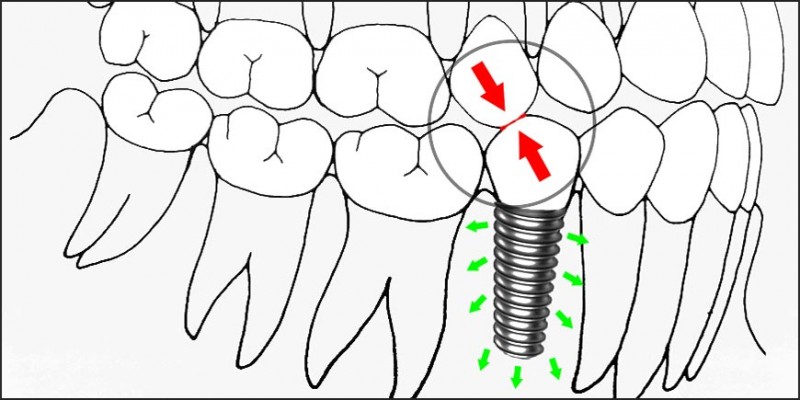 A diagram of teeth with a screw

Description automatically generated