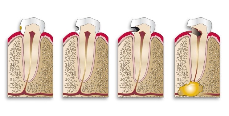 A diagram of a tooth

Description automatically generated with medium confidence