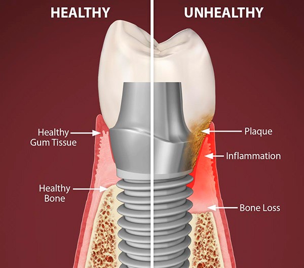 A diagram of a tooth and dental implant

Description automatically generated