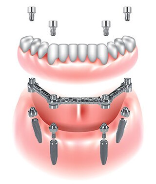 A close-up of a human jaw

Description automatically generated