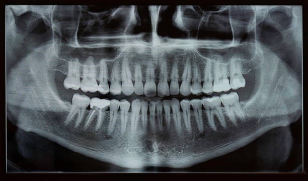 A x-ray of a human teeth

Description automatically generated