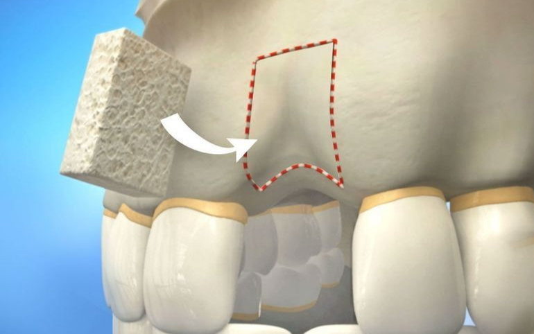 大天使植牙专科 周启诚医生专栏 34 – 可用的不同类型的骨移植材料！