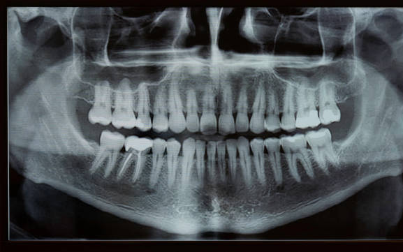 大天使植牙專科 周啓誠醫生專欄 30——讓我們弄明白這一點！