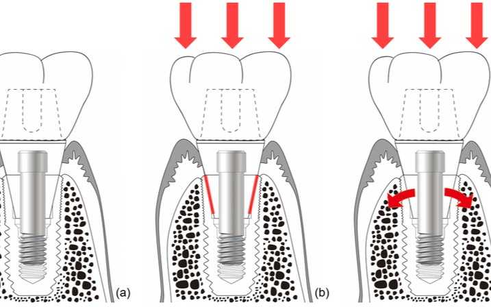 周启诚牙医 专栏 47条 –不同供应商的植牙修复可预测性！