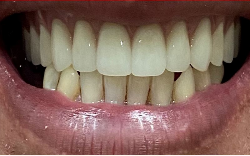 大天使植牙專科 周啓誠醫生專欄7--- 微笑是免費的良藥！