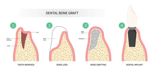 A diagram of a bone graft

Description automatically generated