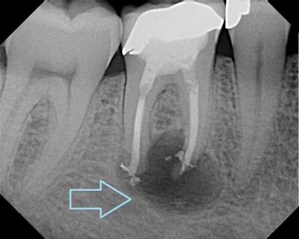 A tooth x-ray showing a tooth decay

Description automatically generated