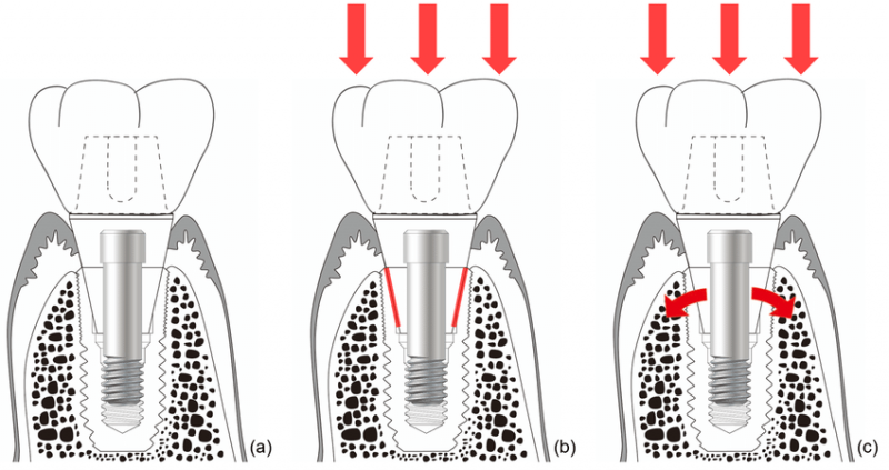 A diagram of a tooth with a screw

Description automatically generated