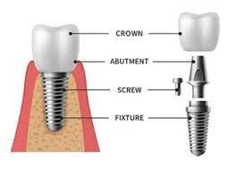 A diagram of a tooth implant

Description automatically generated