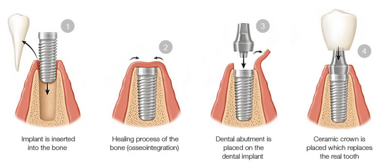 A diagram of a tooth implant

Description automatically generated