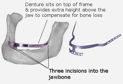 A close-up of a prosthetic jaw

Description automatically generated