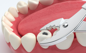 大天使种植牙专科 周启诚医生专栏 26 –您的预后将决定您的种植治疗类型!