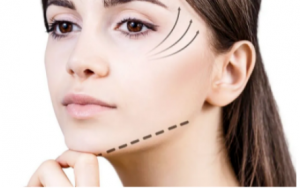 面部松弛下垂的神器--线雕提升 奥斯丁Neo Soma专业医美帮你“拉”回青春！