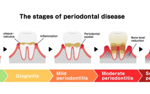 大天使植牙专科 周启诚医生专栏 32 –拖延等待的弊大于利!