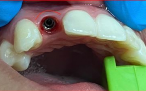 大天使植牙专科 周启诚医生专栏 24条 – 种植牙和美学!