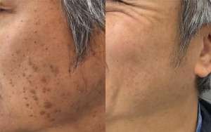 雀斑、黄褐斑、老年斑？ 皮秒一扫光！