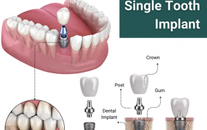 大天使植牙专科 周启诚医生专栏 36 – 单颗牙齿替换!