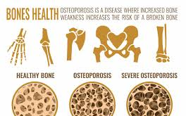 周启诚牙医专栏 55 ——骨质疏松症和牙科诊所的预防措施!