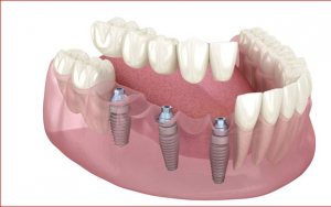 大天使种植牙科  周启诚医生专栏4— 实现植牙最佳美学效果的 3 个基本标准!
