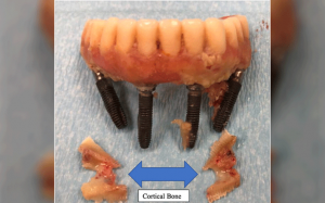 周启诚牙医专栏 53 – 缺乏适当的清洁和维护可能导致全牙弓种植体假体完全失效!