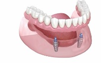 周启诚牙医专栏 54— 我们最受欢迎的植牙选项概览!