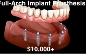 大天使植牙专科 周启诚医生专栏 16条 –植牙的价格