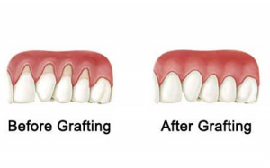周启诚牙医专栏 49  – 什么是软组织移植以及何时需要软组织移植？