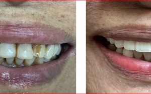 大天使植牙专科 周启诚医生专栏18——向美丽新笑容的转变!