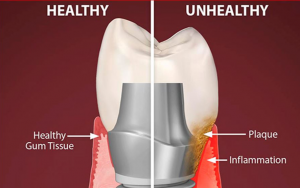 大天使种植牙科  周启诚医生专栏 19条– 什么是种植体周围炎以及如何避免?