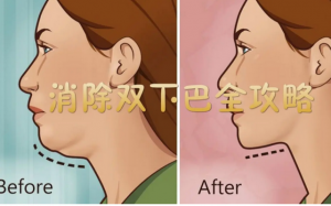 溶脂针快速消除双下巴 和羊腮 奥斯丁NeoSoma专业医美帮您养成侧颜杀