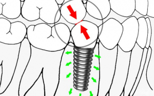 大天使植牙专科 	 周启诚医生专栏 37 - 种植牙医学中的生物力学!