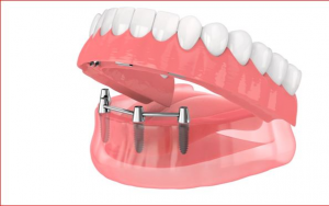 大天使植牙专科周启成医生专栏8--  脸下部三分之一的老化!