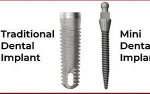 大天使植牙专科 周启诚医生专栏 35 - 可用的牙种植体有哪些类型?