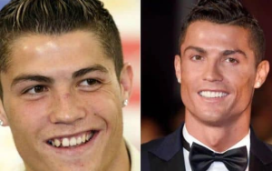 周启诚牙医专栏60-什么是牙贴面？哪些人需要？