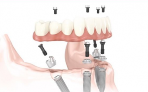 大天使植牙专科 周启诚医生专栏22——All-on-4到底是什么?